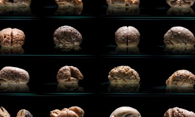 The world’s largest collection of malformed brains