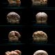 The world’s largest collection of malformed brains